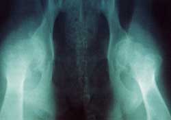 Severe hip displasia (total score:98).There is considerable new boneformation completely altering theanatomies of the 'ball' and the 'socket'on each side