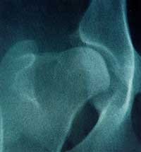 Right hip in close up.Grossdegree of hip dysplasia(singlehip score:32).Both the 'ball'and the 'socket' show markednew bone formation and aredistorted in shape